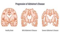 Alzheimer’s or MCI